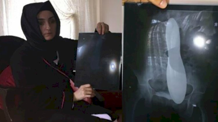 Ameliyatta karnında mala unutulan kadına ödenecek tazminat belli oldu