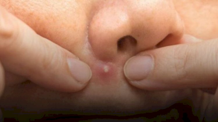 Yüzündeki sivilceyi sıktı: Beyni iltihapla doldu