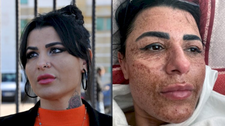 Yüz yakan lazer uygulamasına verilen ceza belli oldu