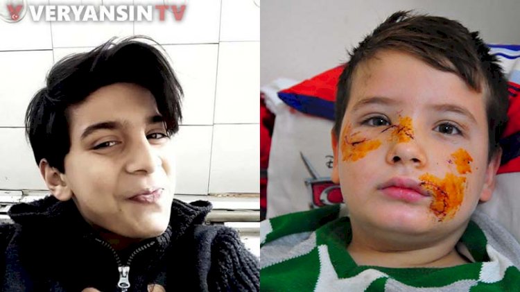 Enes'i köpek sürüsü parçaladı... Mert'in yüzüne 60 dikiş atıldı