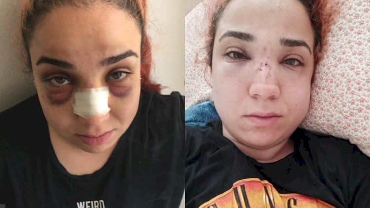 Kadın çalışanın burnunu kıran patrona hapis istemi