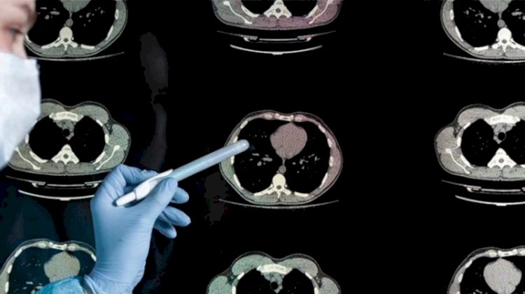 Çocuklarda koronavirüs sonrası beyinde 'apse' tehlikesi